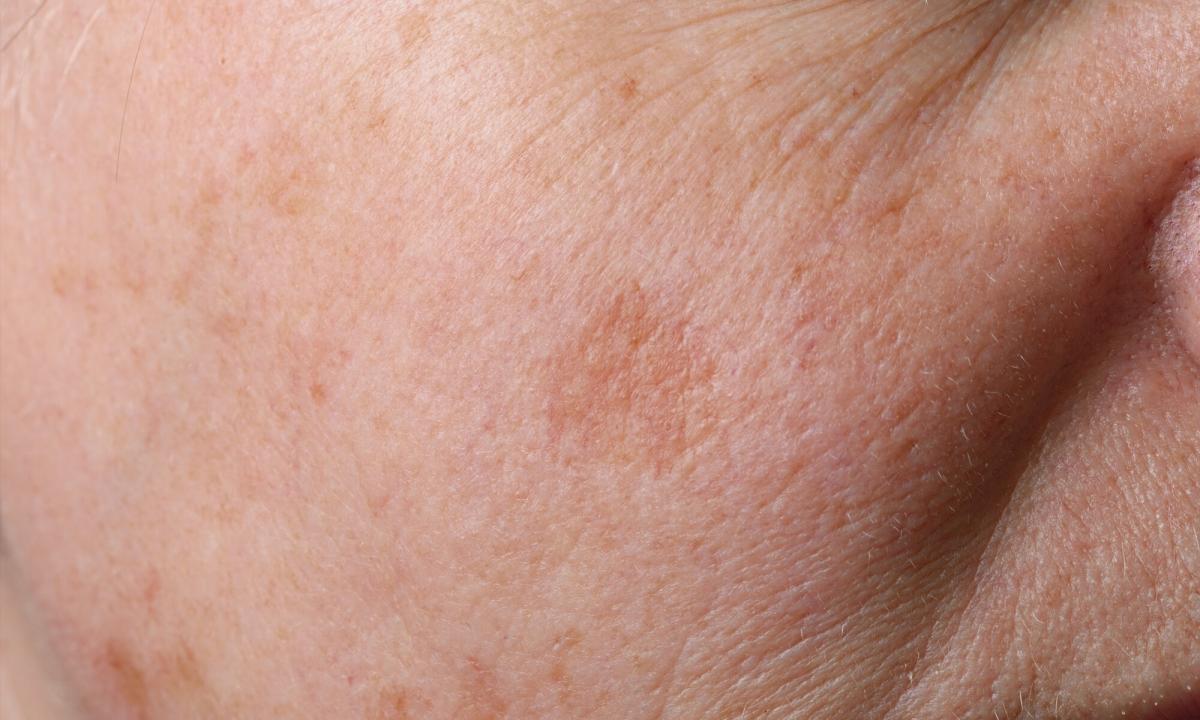 How to remove senile pigmental spots