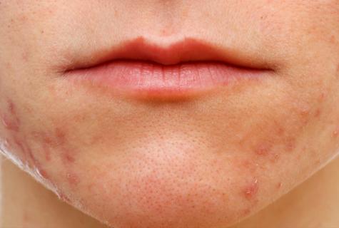 How to prevent acne rash on skin
