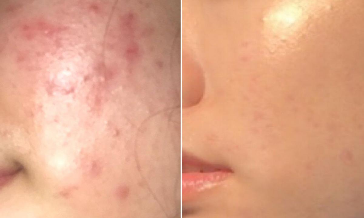 How quickly to remove redness from pimples