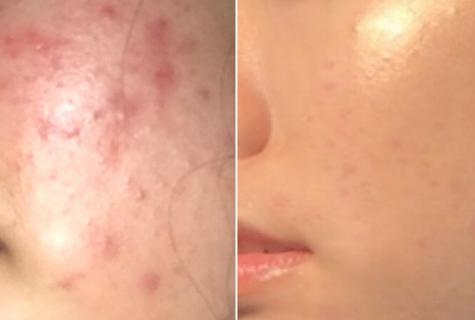 How quickly to remove redness from pimples