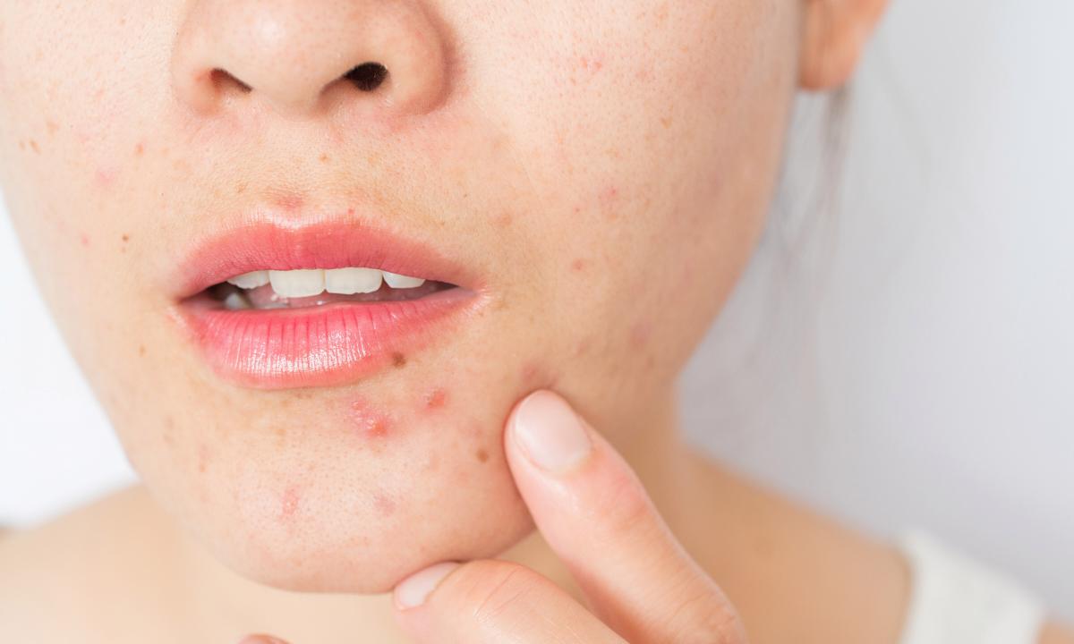 How to get rid of spots after pimples