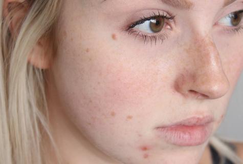 How to get rid of capillaries on face