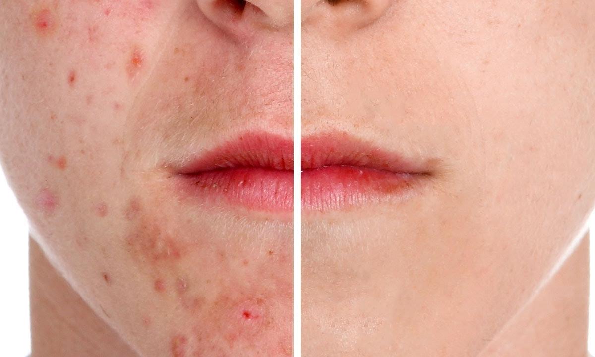 How to remove pimples without folk remedies