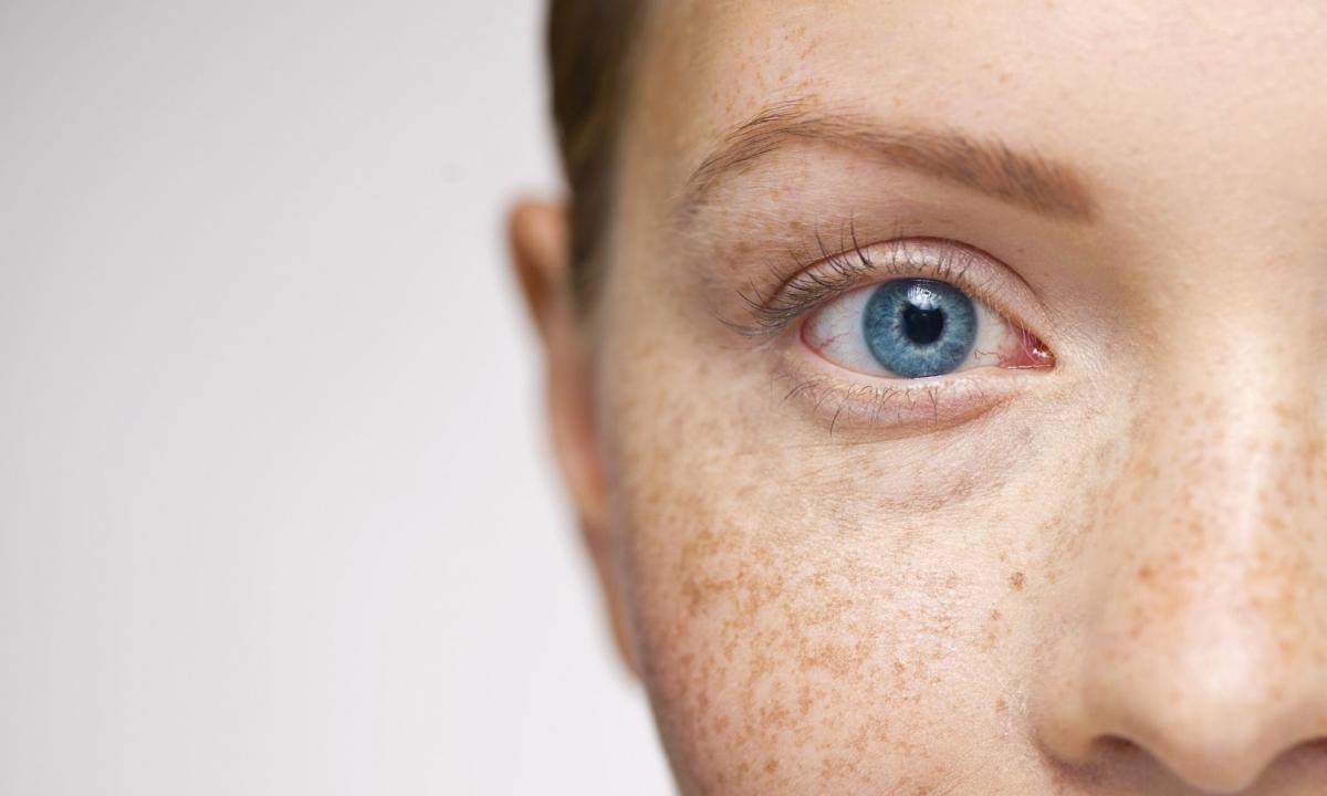 How to get rid of shoulder freckles