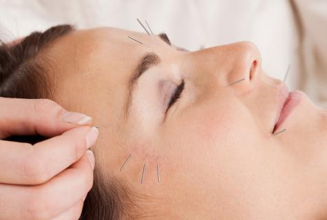 What is acupuncture face lifting