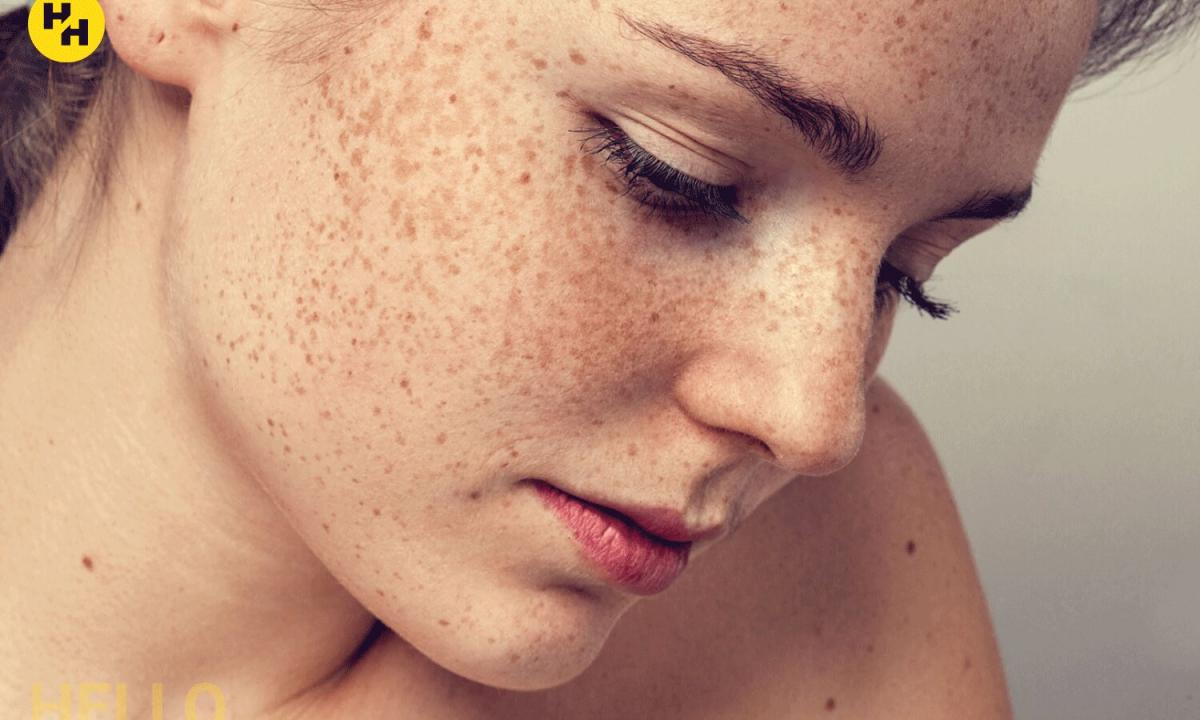 Folk remedies for fight against freckles