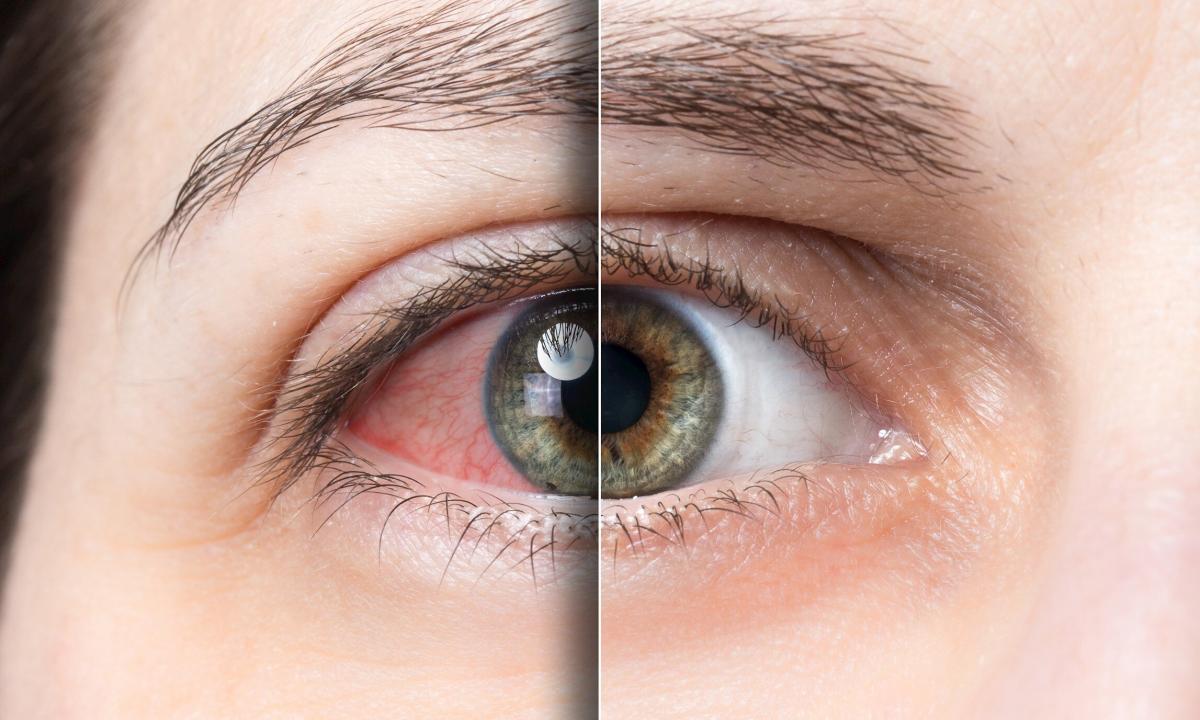 How to get rid of vessels in eye