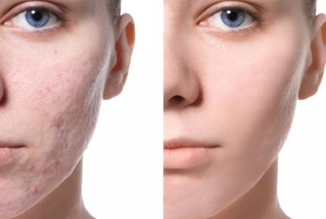 How to remove reddening on face quickly