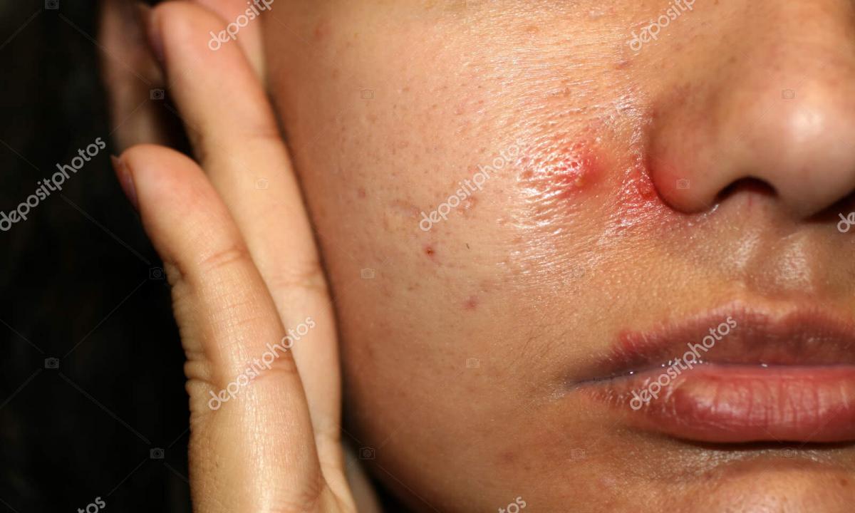 How to remove the inflamed pimple