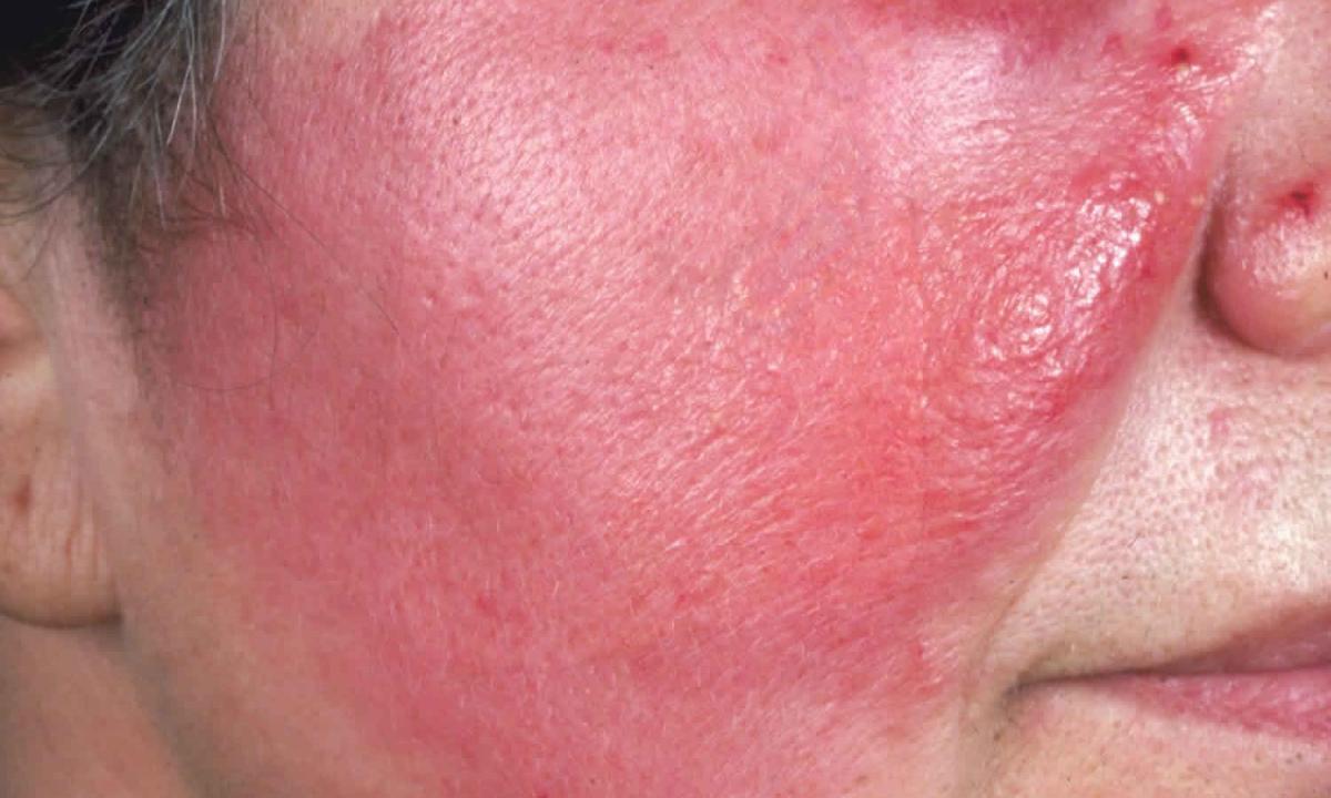 How to remove cellulitis house conditions?