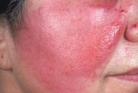 How to remove cellulitis house conditions?