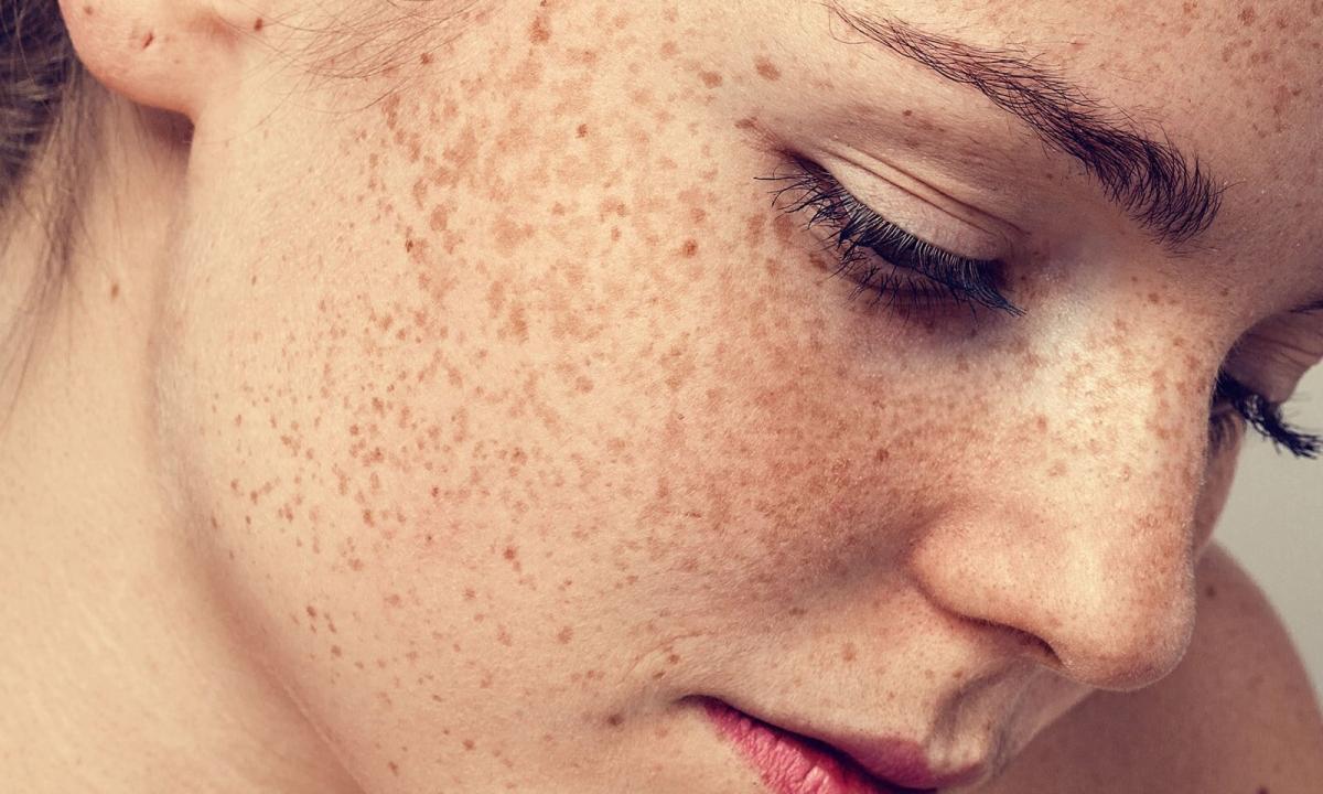 How to get rid of back freckles