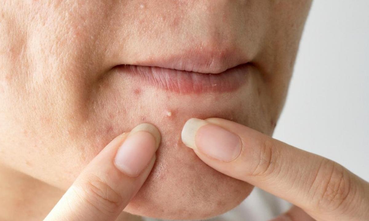 The causes of pimples on chin