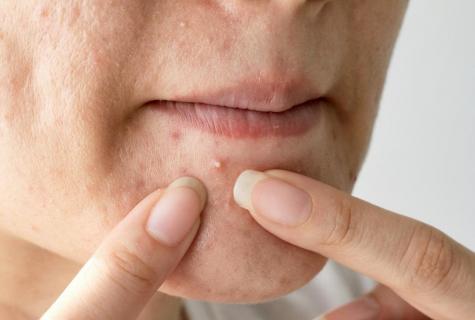 The causes of pimples on chin
