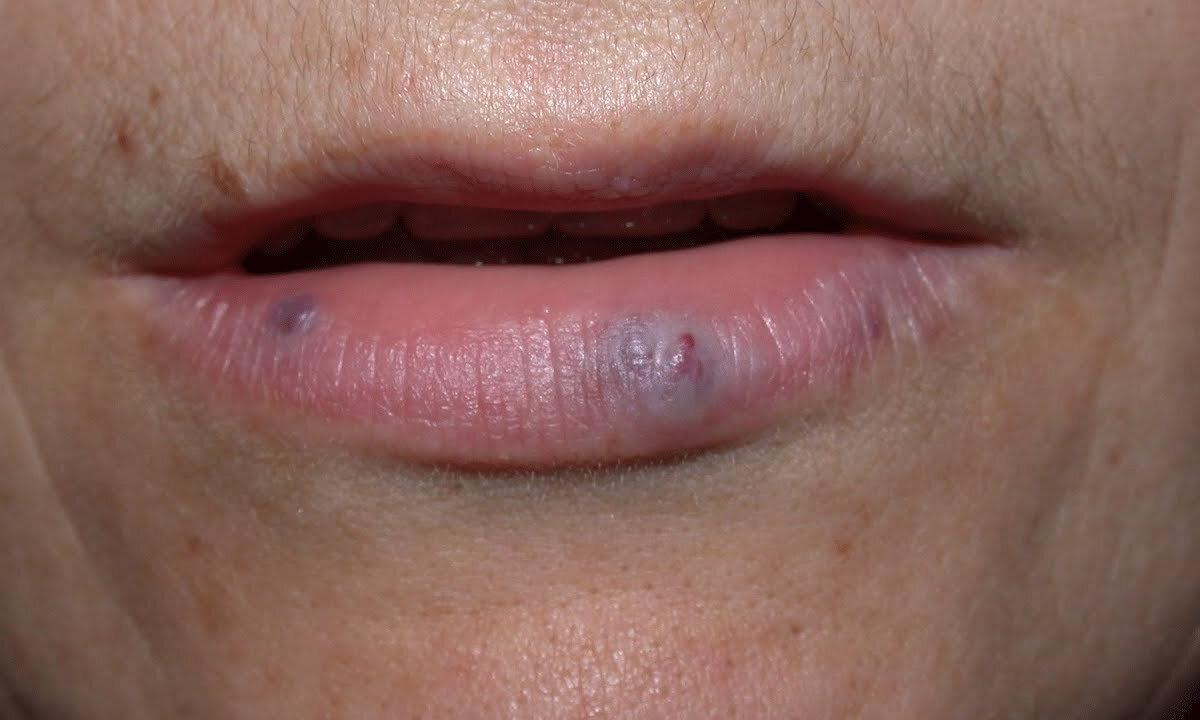 How to remove tumor on lip