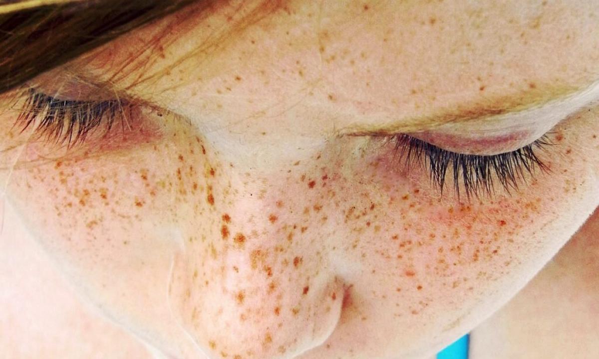 How to prevent emergence of freckles