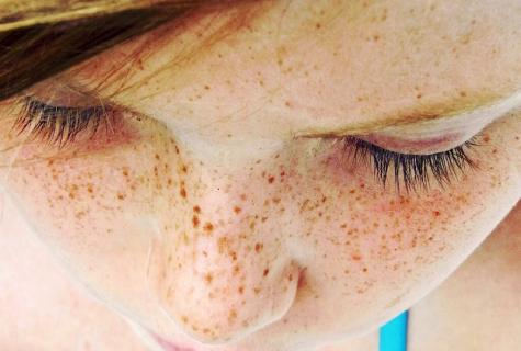 How to prevent emergence of freckles