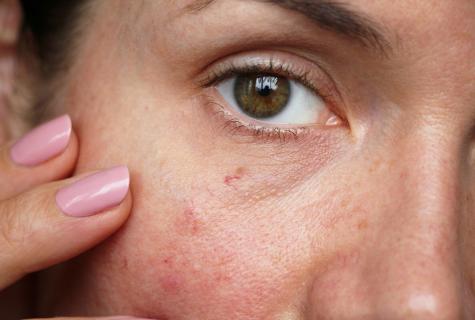 How to remove capillaries from face