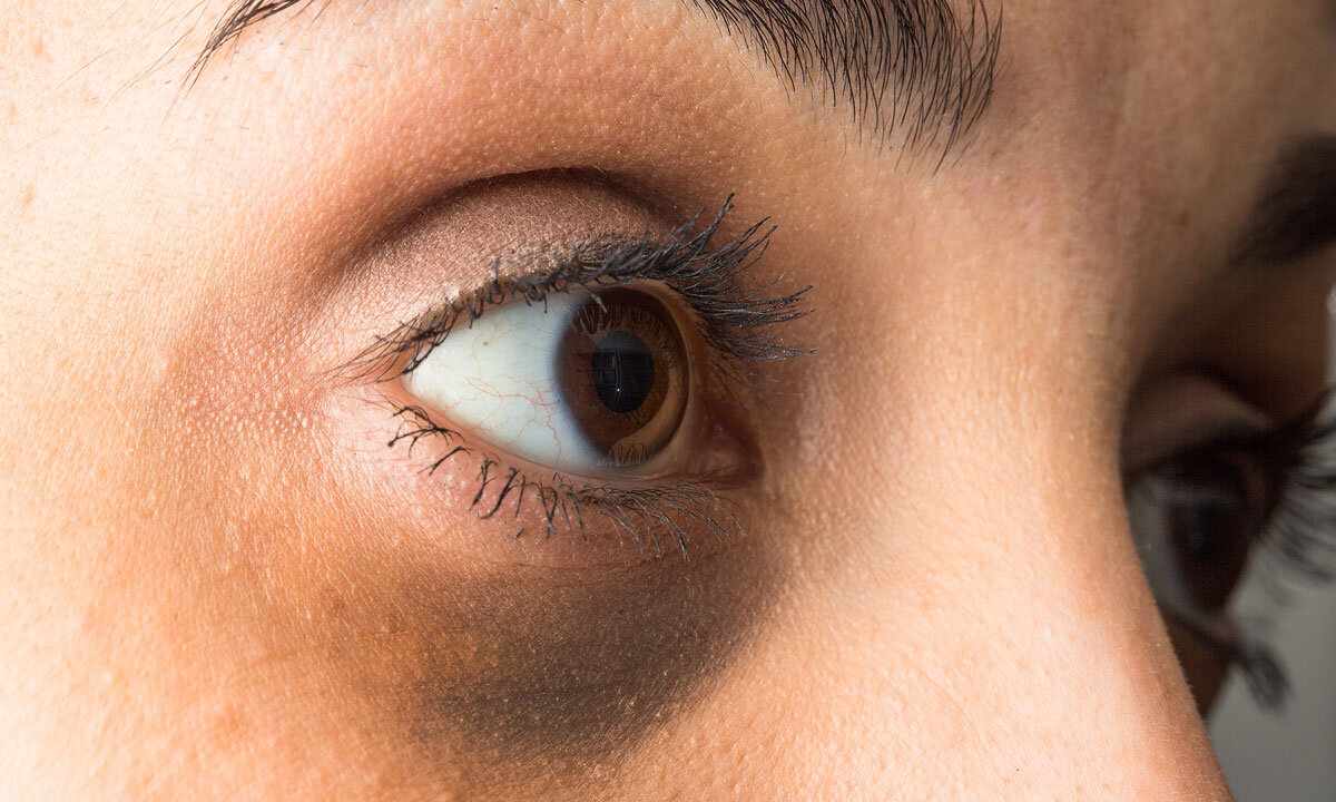 How to remove shadows under the eyes folk remedies