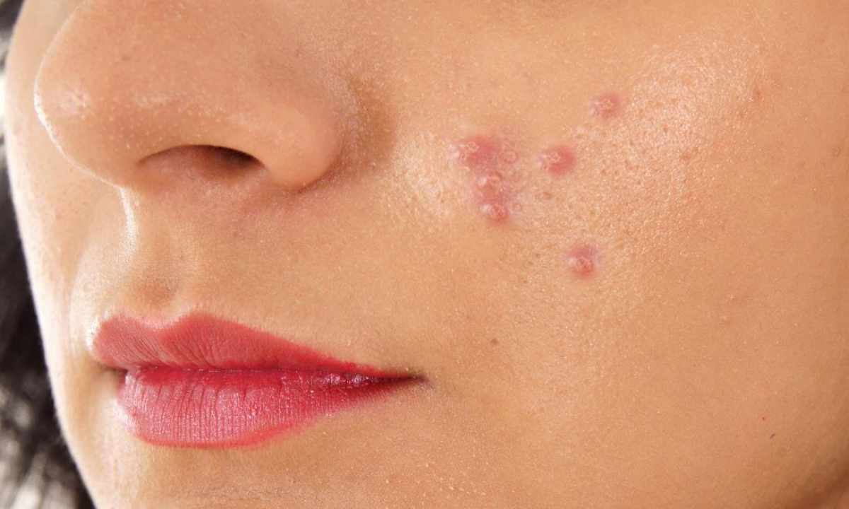 How to get rid of wounds after pimples