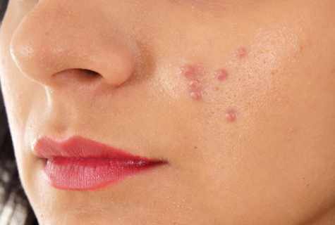 How to get rid of wounds after pimples