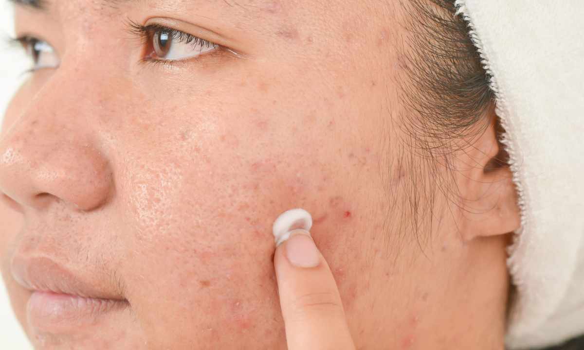 How to get rid of acne spots