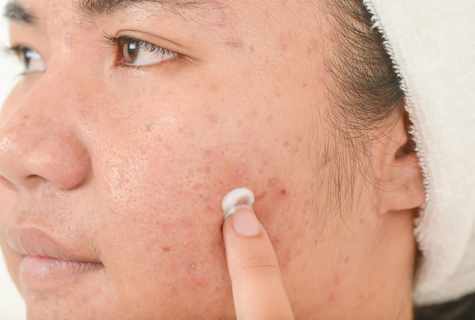 How to get rid of acne spots