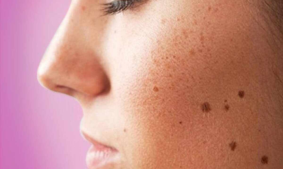 How to get rid of red dots on face