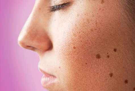 How to get rid of red dots on face