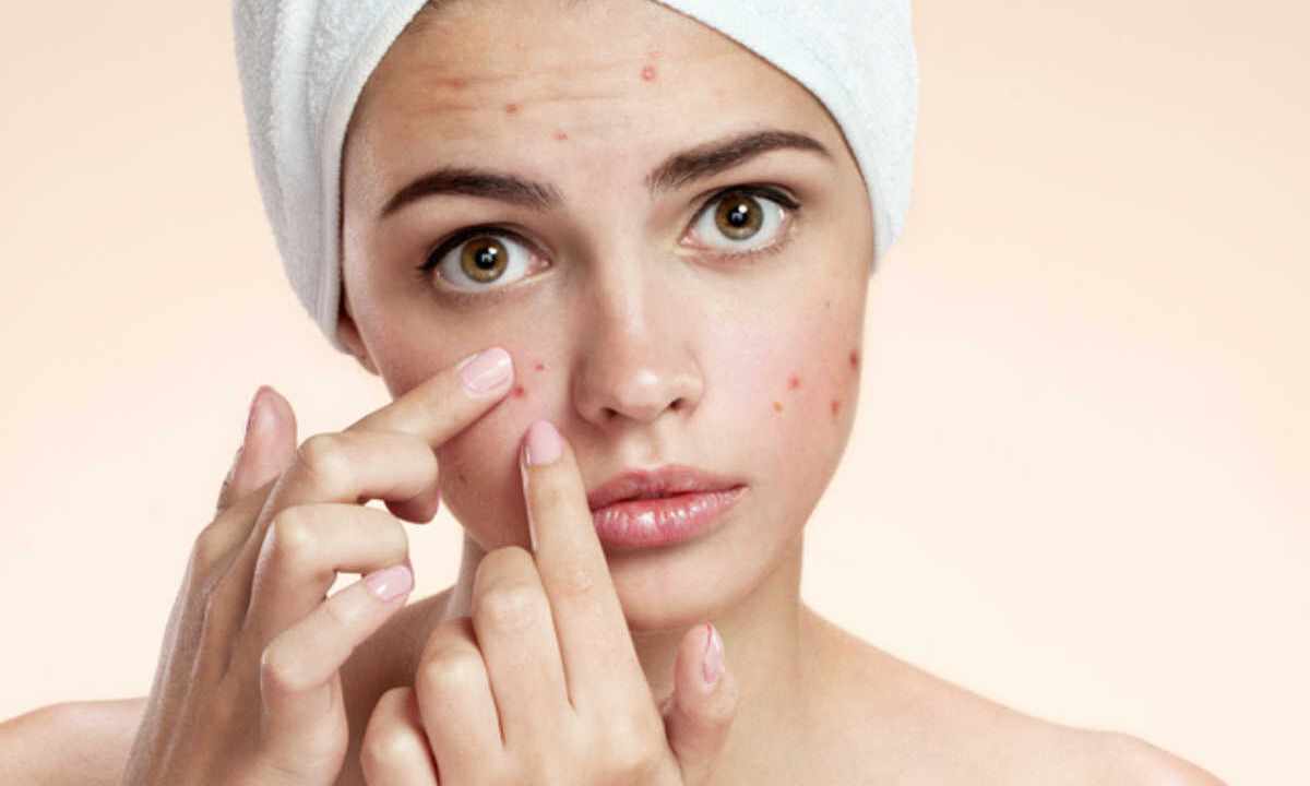 How to overcome pimples