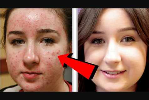How to remove traces from post-acne