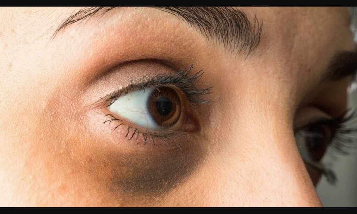 How to get rid of shadows under the eyes in house conditions