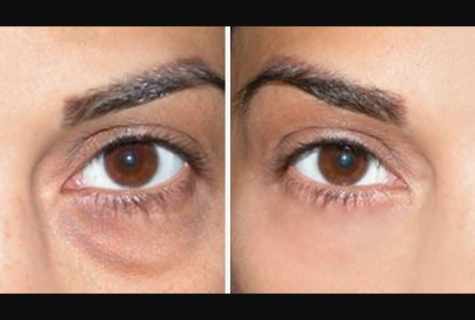 How to remove bags and hypostases under eyes