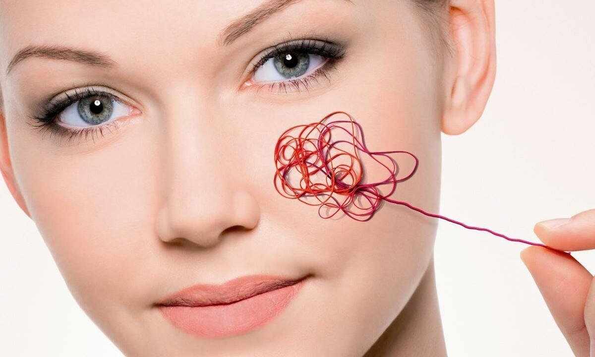 How to get rid of vascular asterisks on face