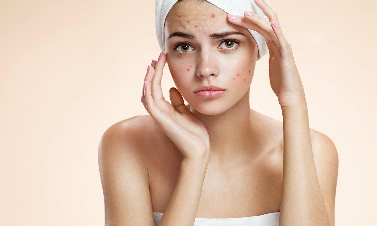 How to struggle with pimples of various look on face