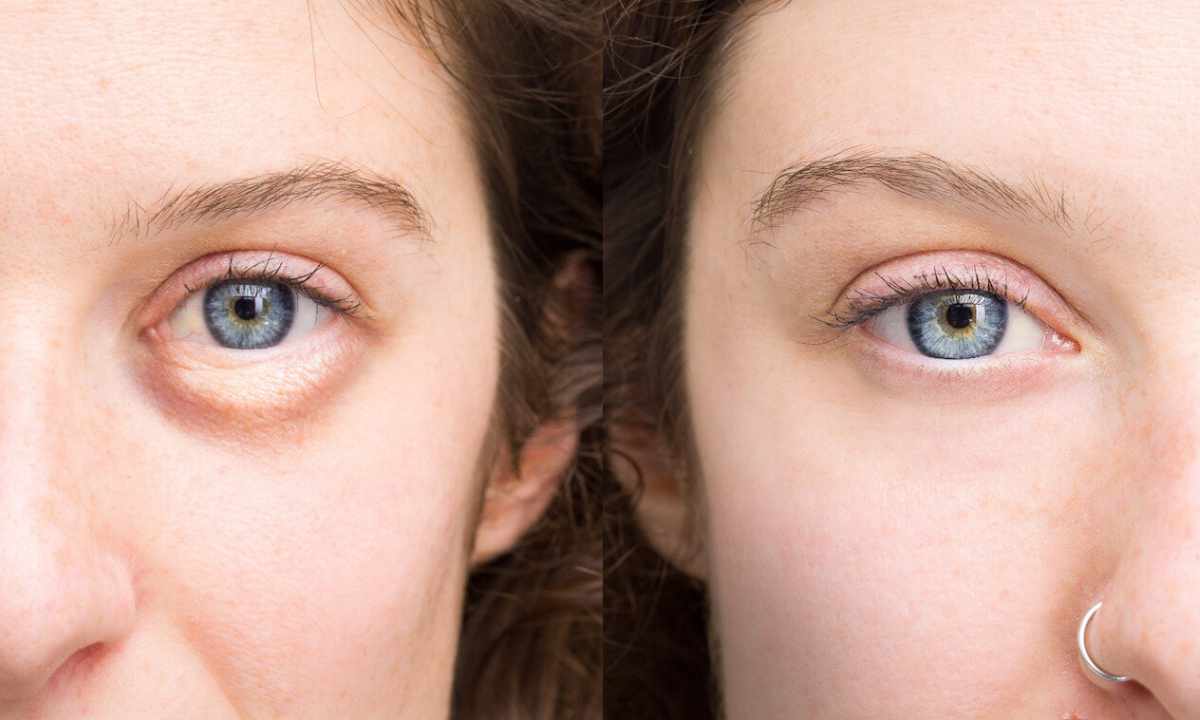 Why eyes swell up in the morning and as to get rid of it