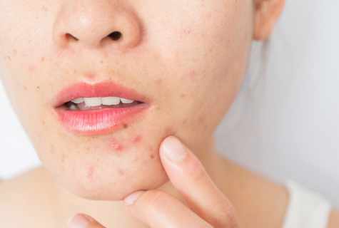How to get rid of traces and spots from pimples