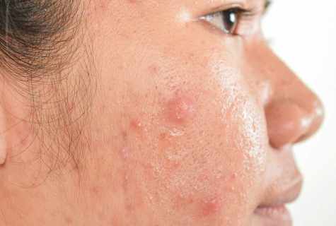 How quickly to remove pimples from face house conditions
