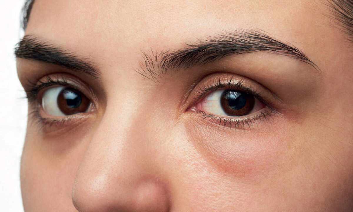 Reasons of puffiness of eyes
