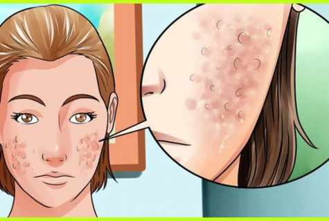 How to get rid of pimples make-shifts