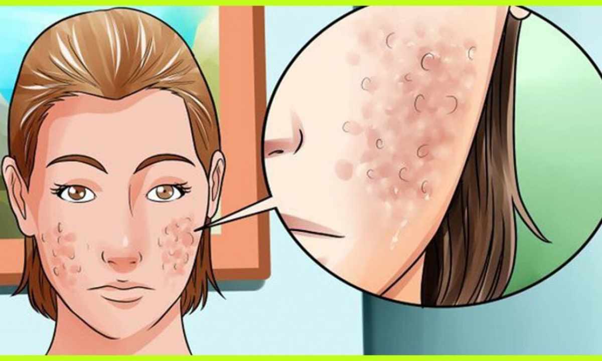 How to clean face from pimples and eels