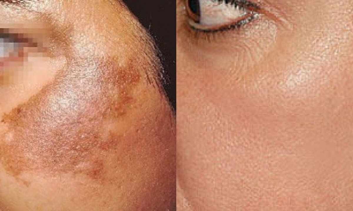 How to remove pigmental spots house conditions