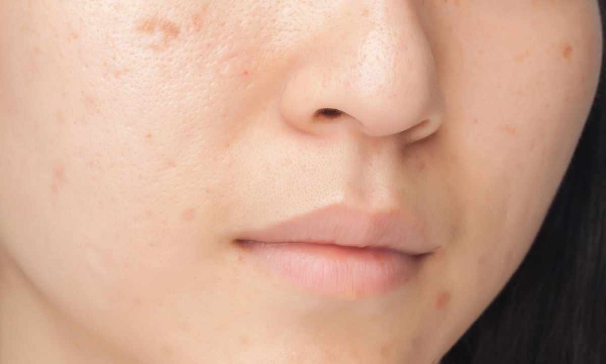 How to remove birthmarks from face