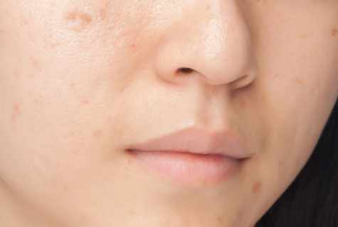 How to remove birthmarks from face