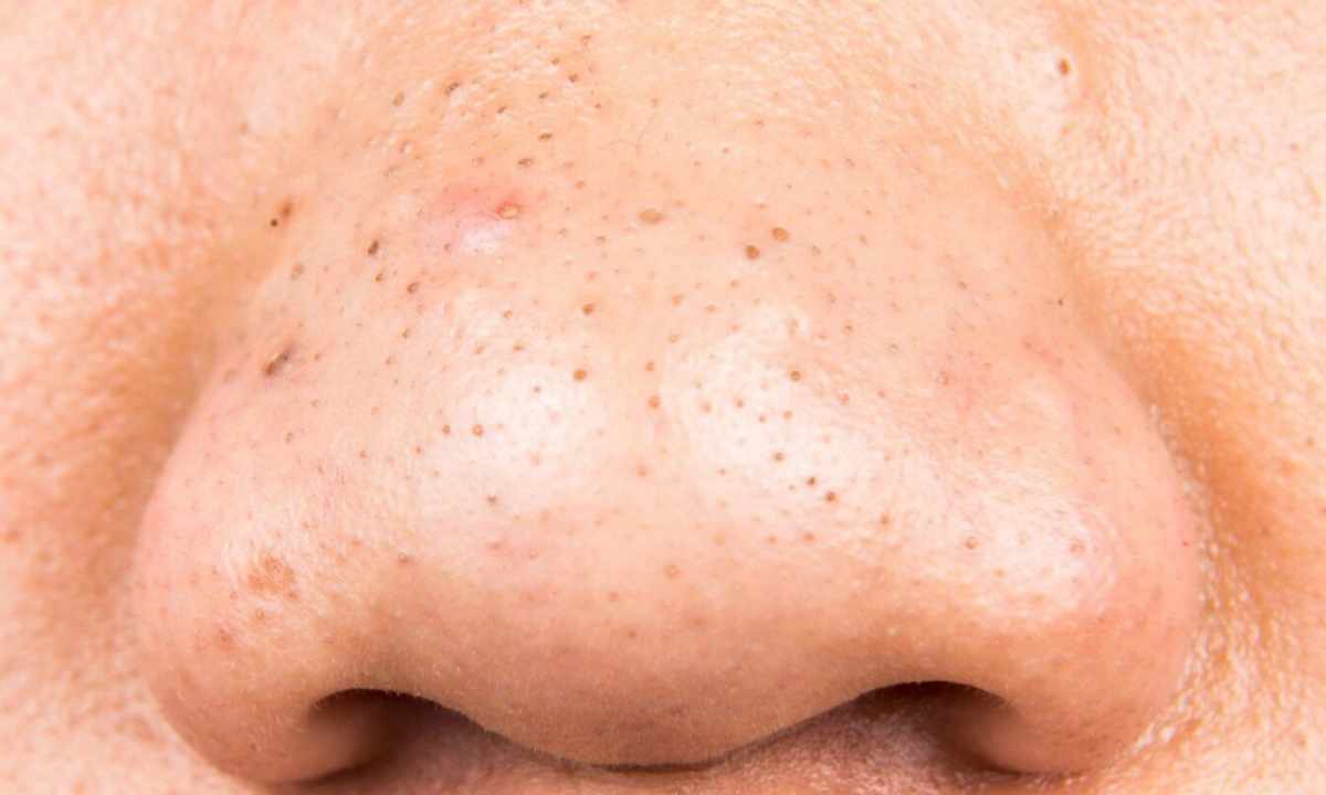 How to get rid of small pimples