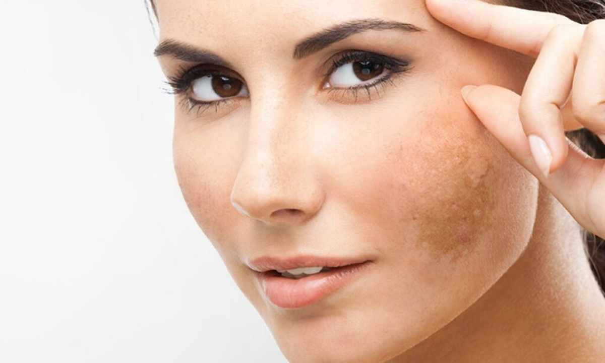 How to remove pigmentation