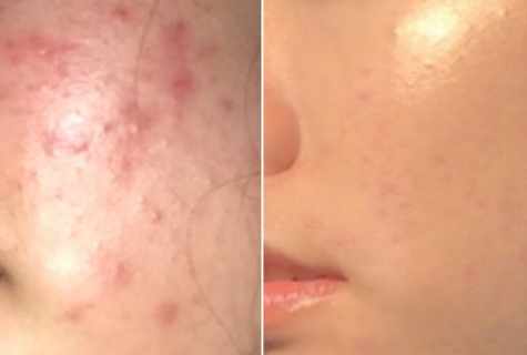 How to get rid of scars from pimples by means of turmeric