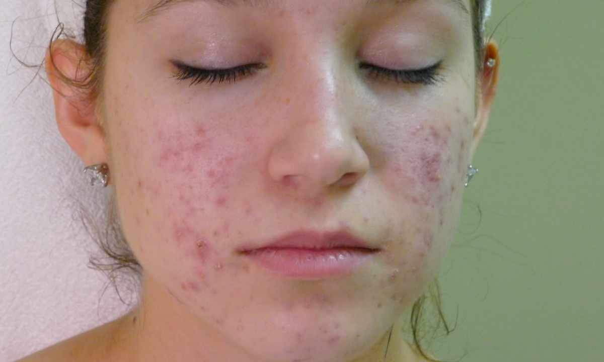 Why there is rash on face