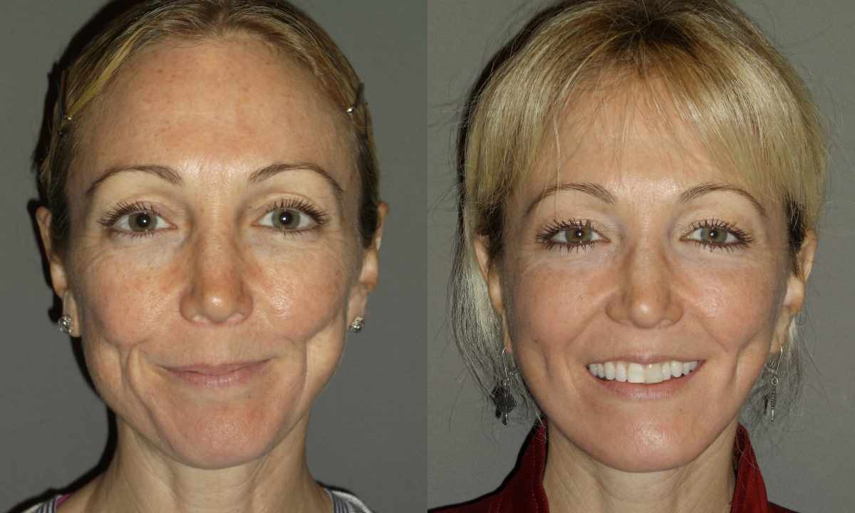 How to keep youth not to resort to plastic surgeries