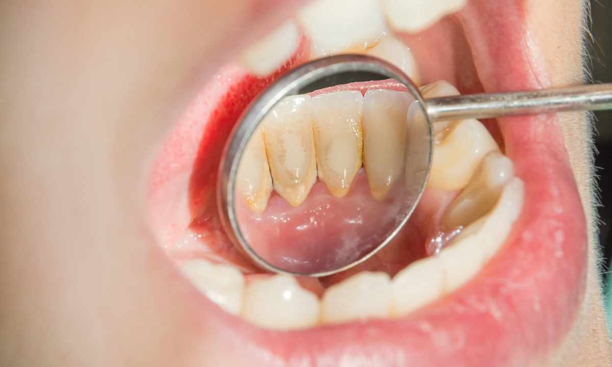 How to remove dental plaque